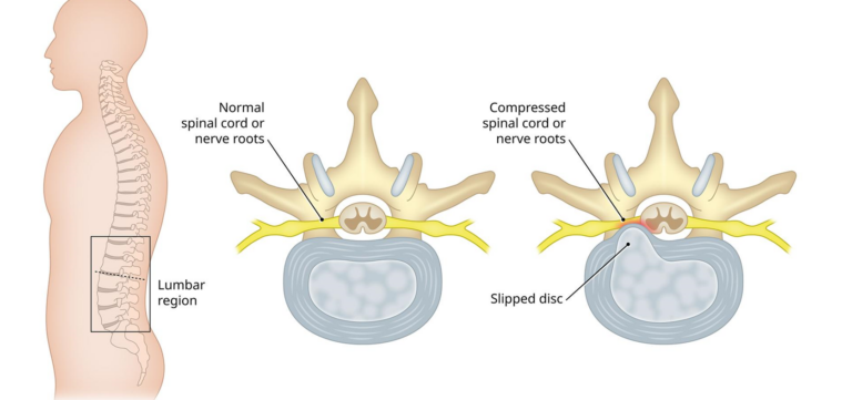 Unlocking Relief: Exploring Minimally Invasive Treatments for Lumbar ...